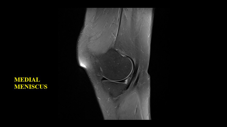 knee mri scan